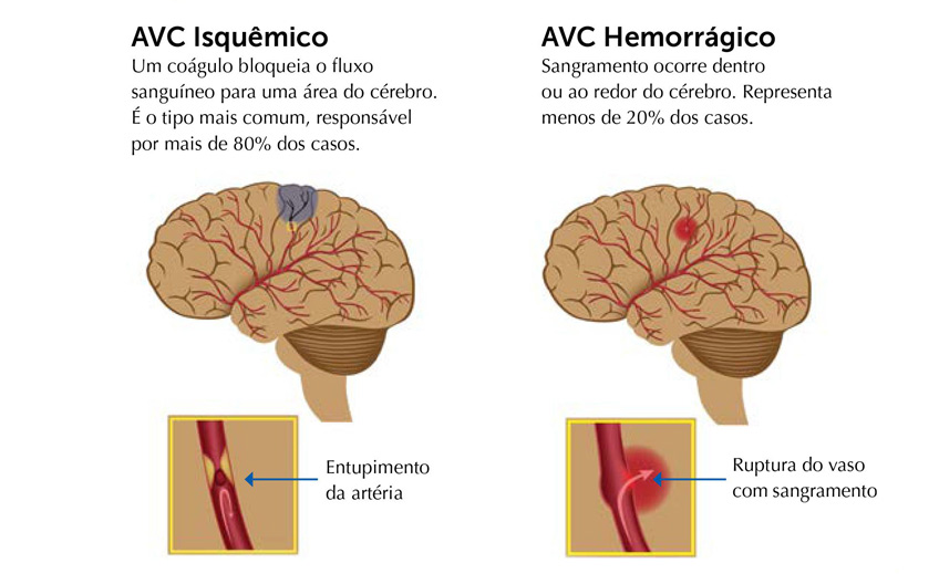 Doenças Cerebrovasculares (AVC)
